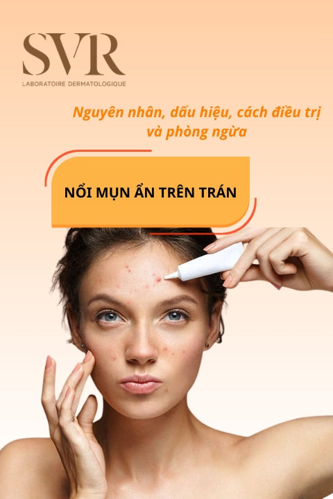 mụn ẩn trên trán