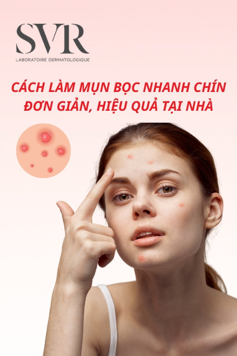 Cách làm mụn bọc nhanh chín đơn giản, lành tính, hiệu quả tại nhà