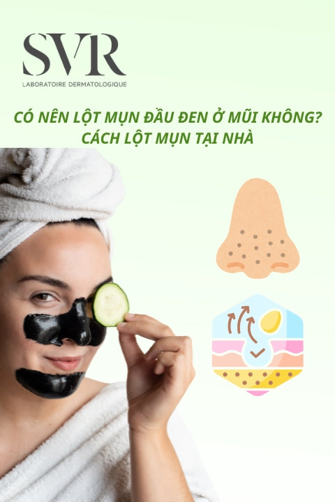 Có nên lột mụn đầu đen ở mũi không? Cách lột mụn tại nhà