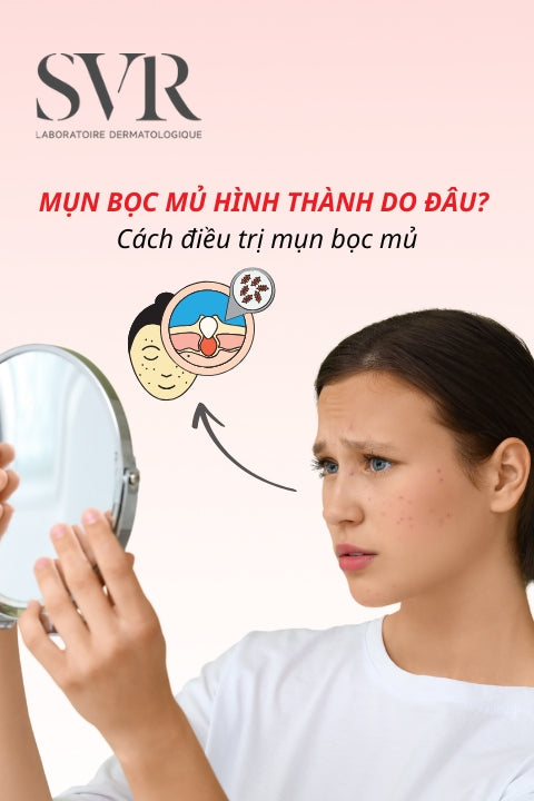 Mụn bọc mủ hình thành do đâu? Cách điều trị mụn bọc mủ hiệu quả