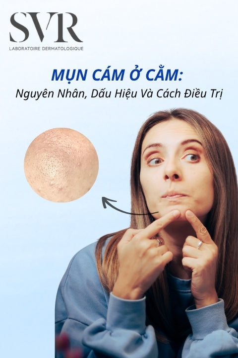 Mụn cám ở cằm: Nguyên nhân, dấu hiệu và cách điều trị an toàn, hiệu quả