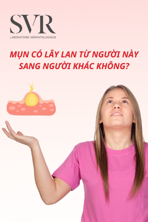 Mụn có lây lan từ người này sang người khác không?