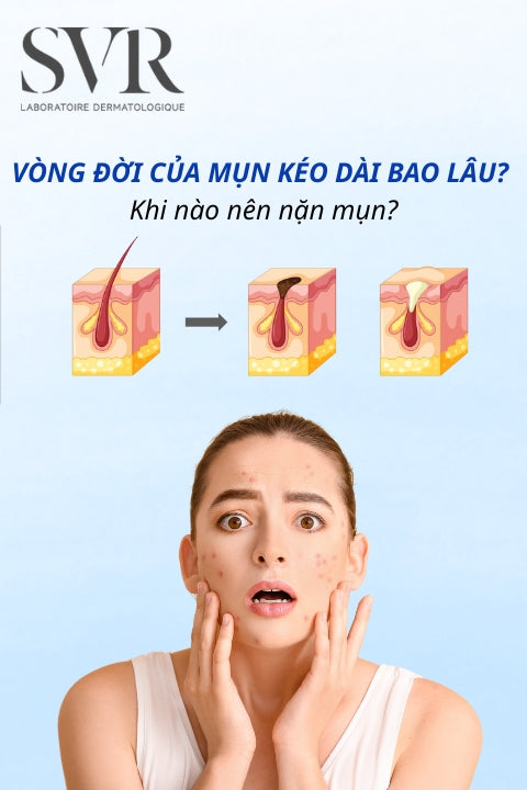Vòng đời của mụn kéo dài bao lâu? Khi nào nên nặn mụn?