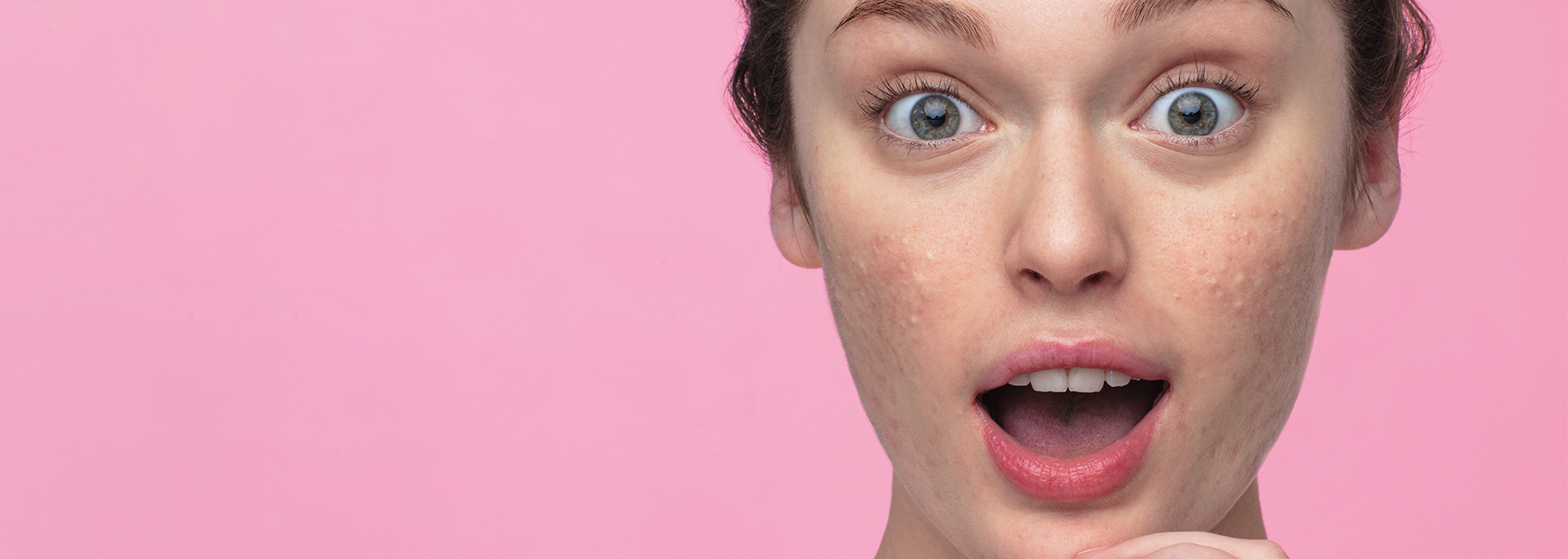 dòng sản phẩm trị mụn SVR Sebiaclear