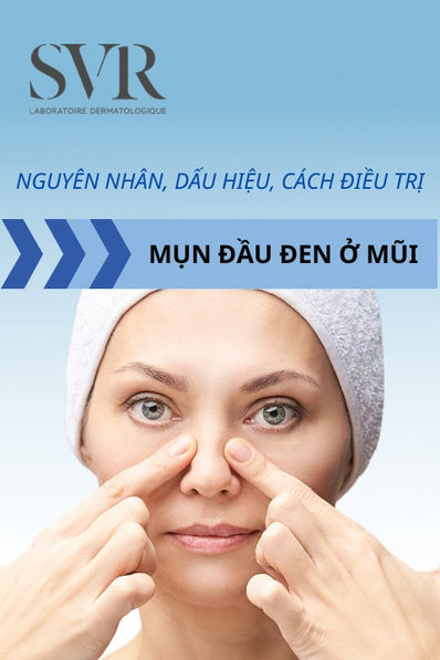 mụn đầu đen ở mũi