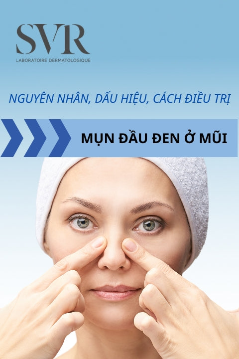 mụn đầu đen ở mũi