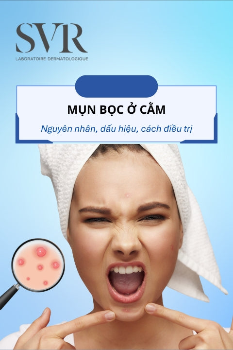 mụn bọc ở cằm