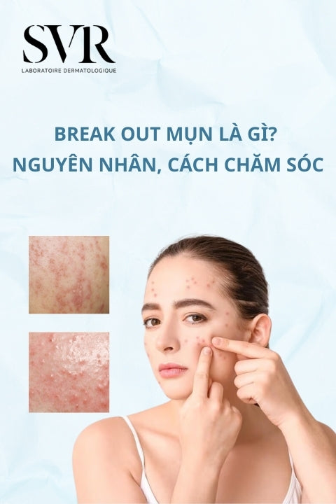 Break out mụn là gì? Nguyên nhân, cách xử lý khi da bị break out