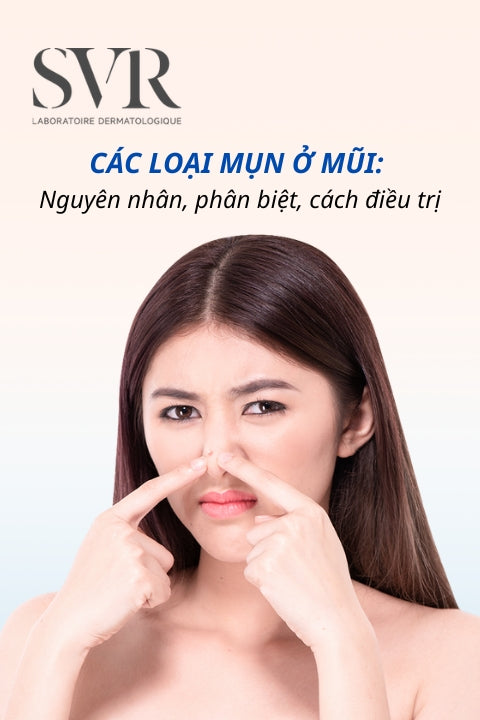 Các loại mụn ở mũi: Nguyên nhân, phân biệt, cách điều trị dứt điểm