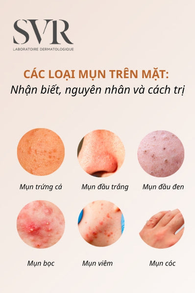 các loại mụn