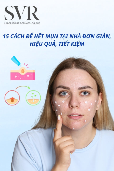 15 cách để hết mụn tại nhà đơn giản, hiệu quả, tiết kiệm