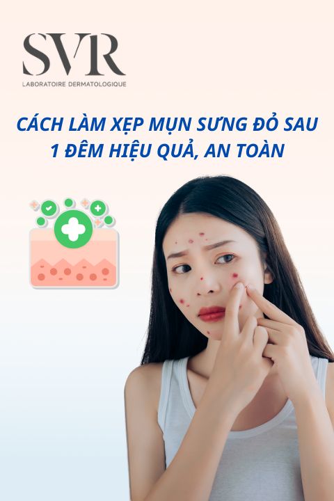 Cách làm xẹp mụn sưng đỏ sau 1 đêm hiệu quả, an toàn