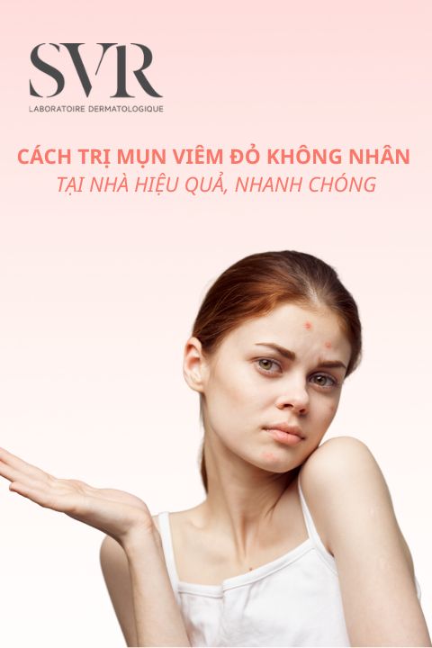 Cách trị mụn viêm đỏ không nhân tại nhà hiệu quả, nhanh chóng