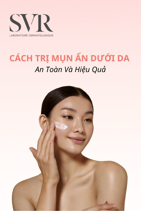 15 Cách trị mụn ẩn dưới da hiệu quả, được bác sĩ da liễu khuyên dùng