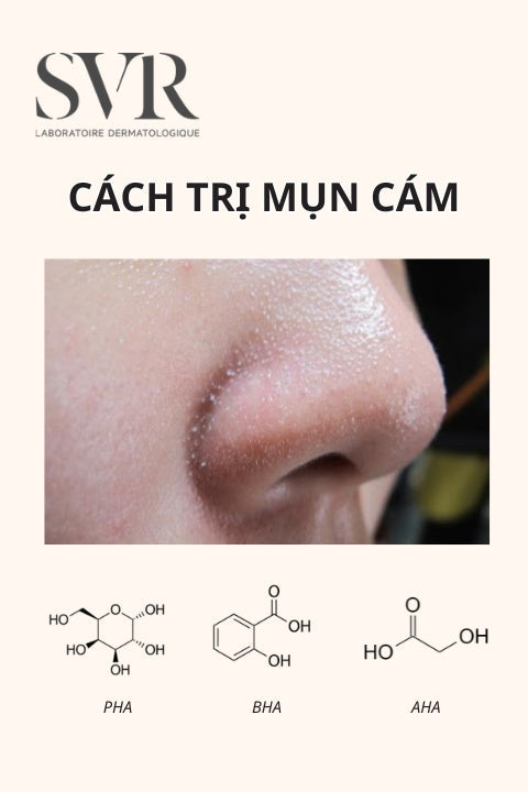 cách trị mụn cám