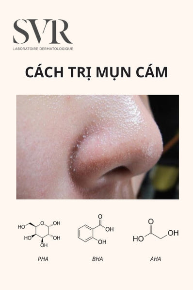cách trị mụn cám