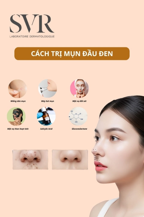 Cách trị mụn đầu đen