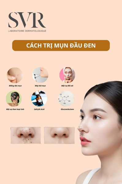 Cách trị mụn đầu đen
