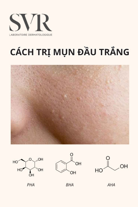 cách trị mụn đầu trắng