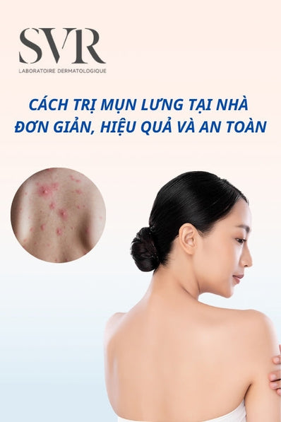 Cách trị mụn lưng tại nhà đơn giản, hiệu quả và an toàn