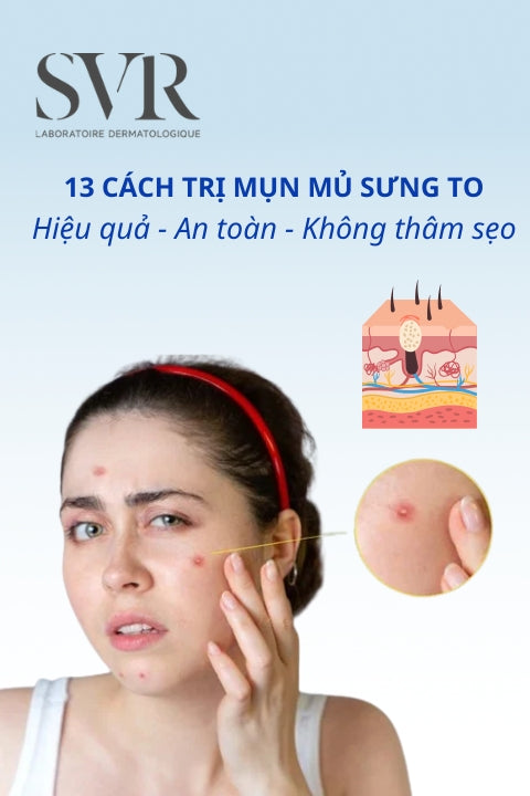 TOP 16 Cách trị mụn mủ hiệu quả, an toàn, không để lại thâm sẹo