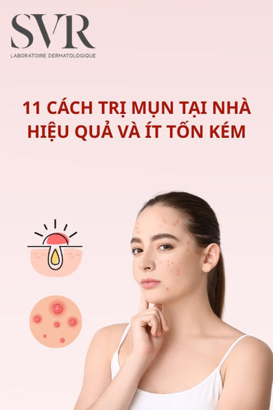 11 cách trị mụn tại nhà hiệu quả và ít tốn kém