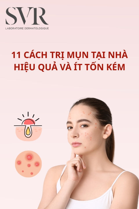 11 cách trị mụn tại nhà hiệu quả và ít tốn kém