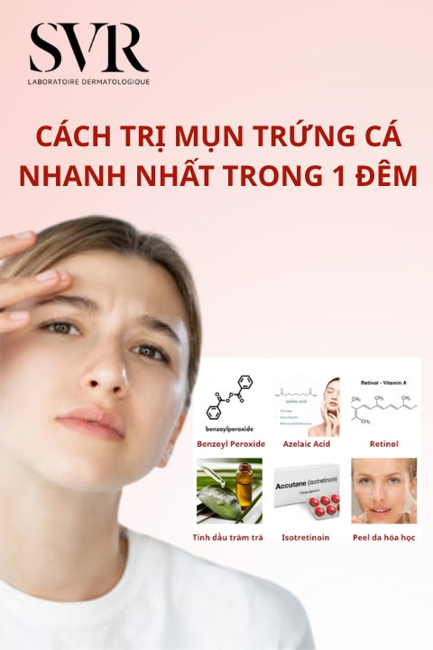 Top 16 cách điều trị mụn trứng cá nhanh nhất trong 1 đêm