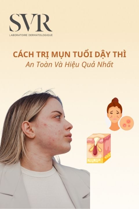 25+ Cách trị mụn tuổi dậy thì an toàn, hiệu quả