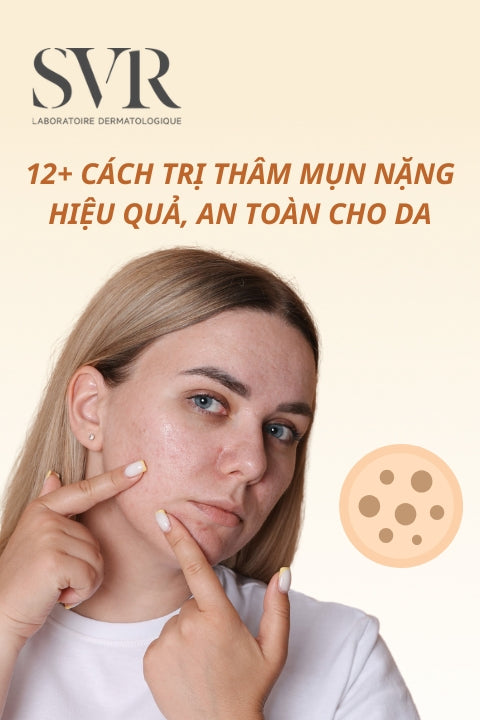 12+ Cách trị thâm mụn nặng hiệu quả, an toàn cho da