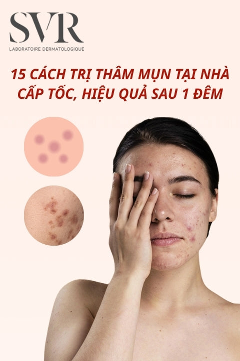 15 Cách trị thâm mụn tại nhà cấp tốc, hiệu quả sau 1 đêm