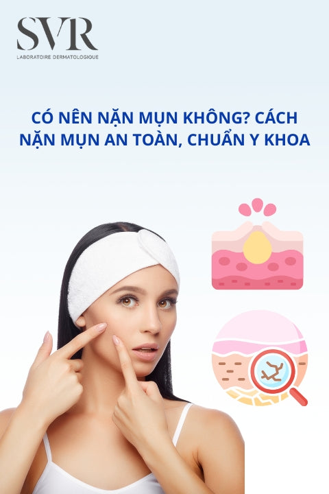 Có nên nặn mụn không? Cách nặn mụn an toàn, chuẩn y khoa