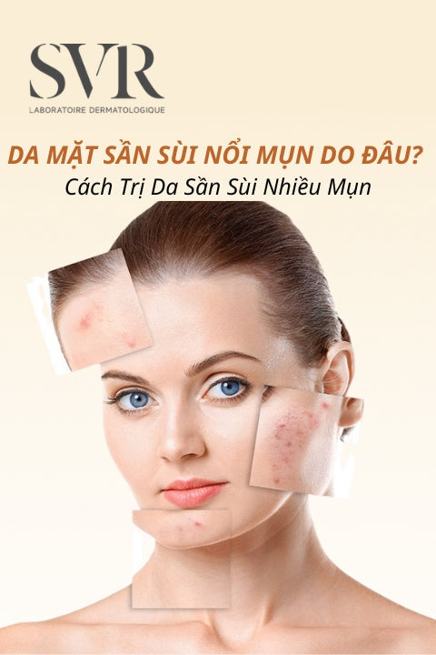 Da mặt sần sùi nổi mụn li ti do đâu? Cách cải thiện mụn ẩn da sần sùi hiệu quả