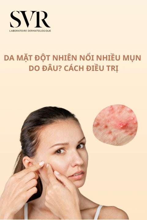 Da mặt đột nhiên nổi nhiều mụn do đâu? Cách điều trị an toàn, hiệu quả