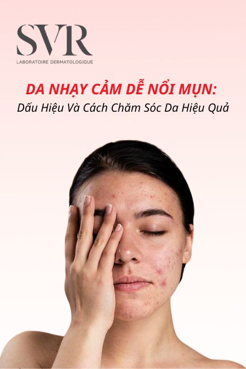 Da nhạy cảm dễ nổi mụn: Dấu hiệu và cách chăm sóc da hiệu quả