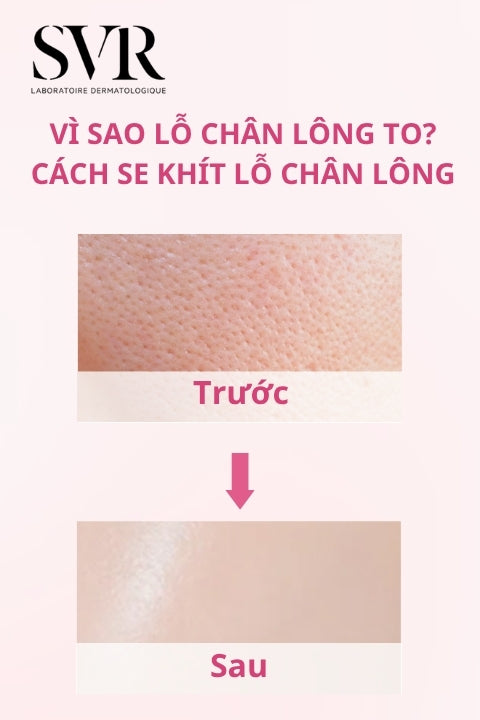 vì sao lỗ chân lông to