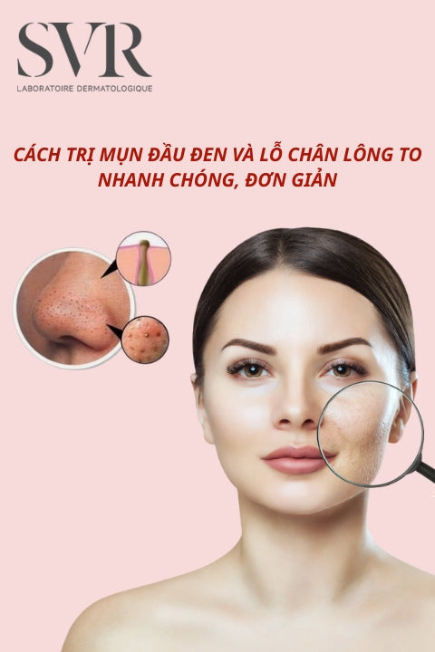 11 Cách trị mụn đầu đen và lỗ chân lông to hiệu quả nhanh, đơn giản