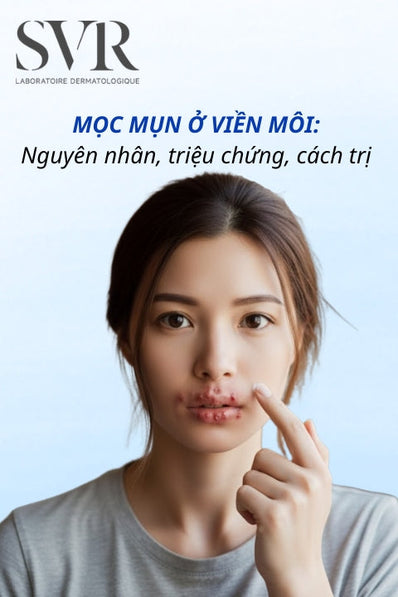 Mọc mụn ở viền môi: Nguyên nhân, triệu chứng, cách trị và phòng ngừa