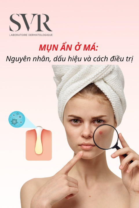Mụn ẩn ở má: Nguyên nhân, dấu hiệu và cách điều trị hiệu quả tại nhà