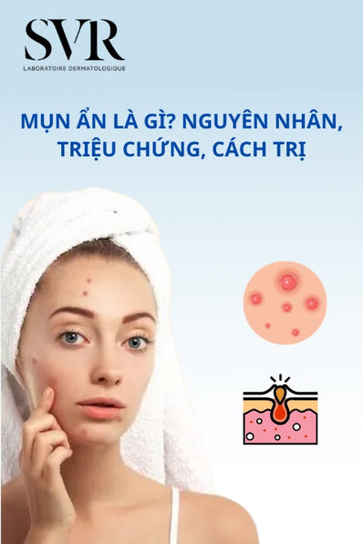 mụn ẩn là gì