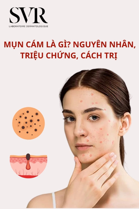 mụn cám là gì
