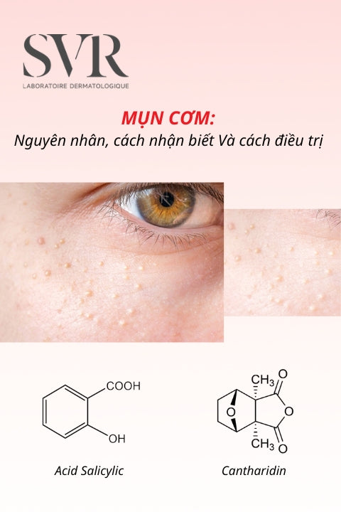 Mụn cơm: Nguyên nhân, cách nhận biết và phương pháp điều trị hiệu quả