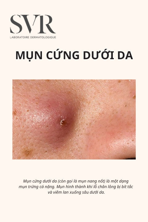 mụn cứng dưới da