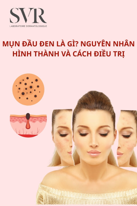 mụn đầu đen
