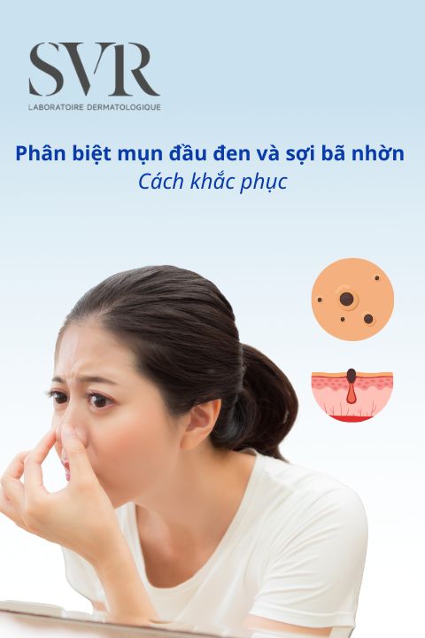 Phân biệt mụn đầu đen và sợi bã nhờn như thế nào? Cách khắc phục