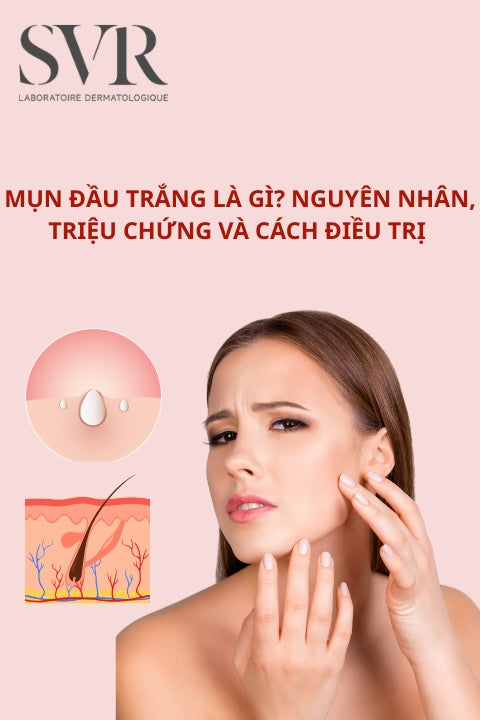 Mụn đầu trắng là gì? Nguyên nhân, triệu chứng và cách điều trị&nbsp;