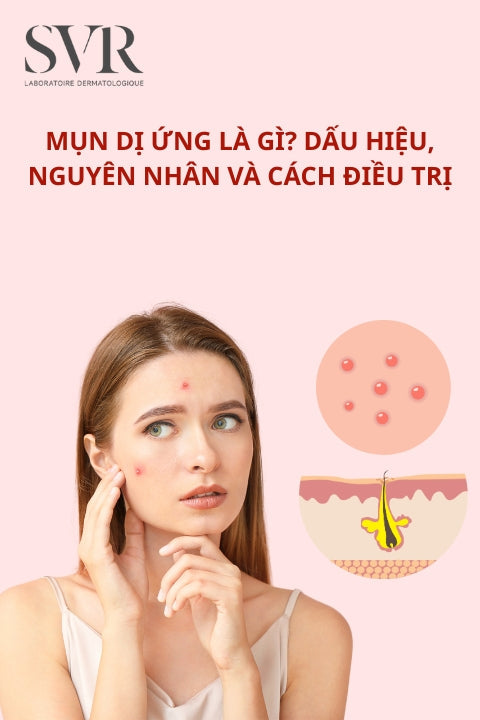 Mụn dị ứng là gì? Dấu hiệu, nguyên nhân và cách điều trị