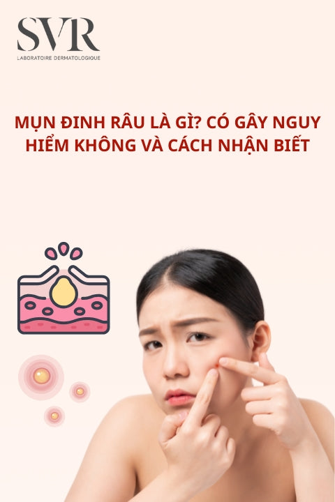 Mụn đinh râu là gì? Có gây nguy hiểm không và cách nhận biết