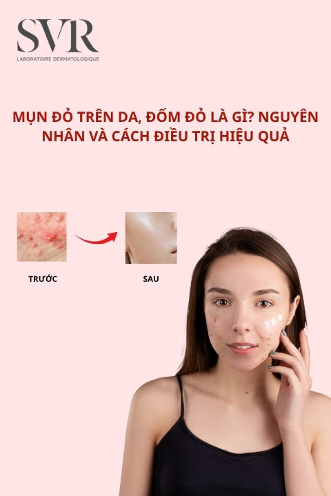 Mụn đỏ trên da, đốm đỏ là gì? Nguyên nhân và cách điều trị hiệu quả
