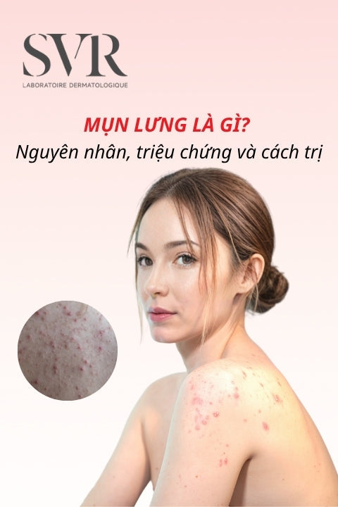 Mụn lưng là gì? Nguyên nhân, triệu chứng và cách trị dứt điểm